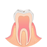 ごく小さな虫歯が歯の表面にできます。