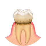 歯茎の縁をはじめ歯の周りの組織に炎症が起きる状態。