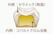 レーザーボンド