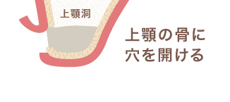 上顎の骨に穴を開ける