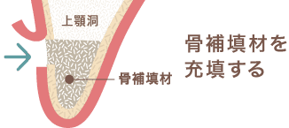 骨補填剤を充填する