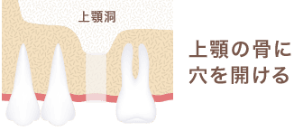 上顎の骨に穴を開ける