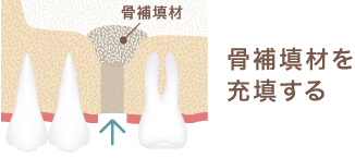骨補填剤を充填する