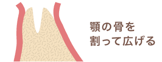 顎の骨を割って広げる