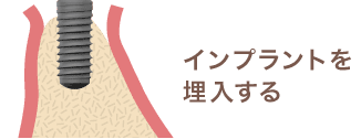 インプラントを埋入する