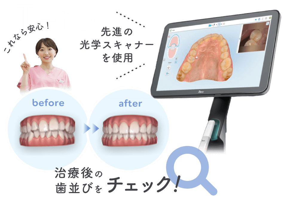 光学印象（iTero）