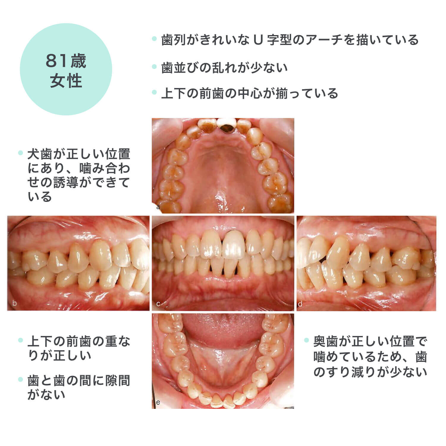 理想的な歯並び（81歳女性）