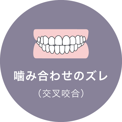 噛み合わせのズレ（交叉咬合）