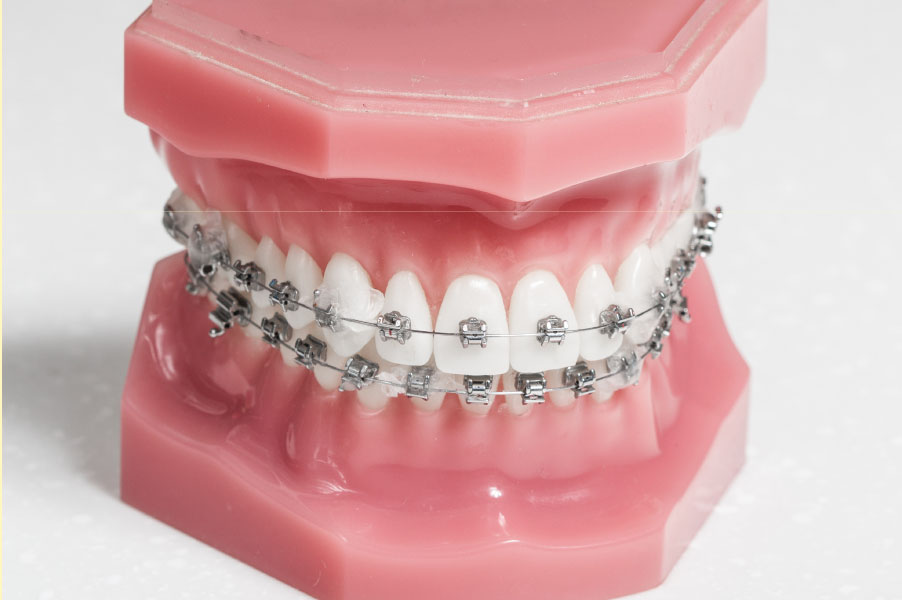 ワイヤー矯正（ブラケット矯正）