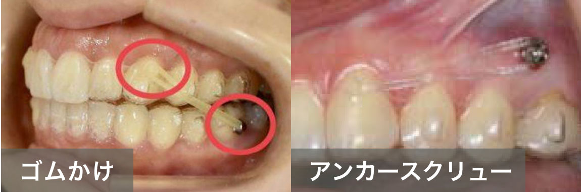 ゴムかけ・アンカースクリュー