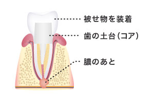 被せ物の装着