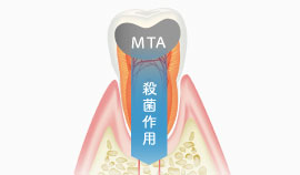 MTAセメント